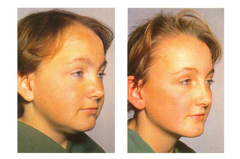 Early facial changes associated with scleroderma