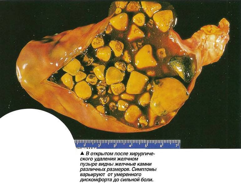 Калькулезный Холецистит Симптомы Диета