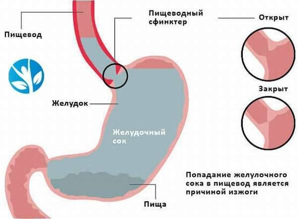 Изжога Причины И Последствия Диета