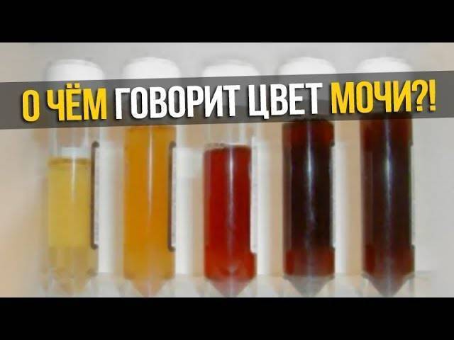 Темная моча у женщин. Моча темного цвета. Темно коричневый цвет мочи. Моча красно-коричневого цвета. Желто-коричневый цвет мочи.