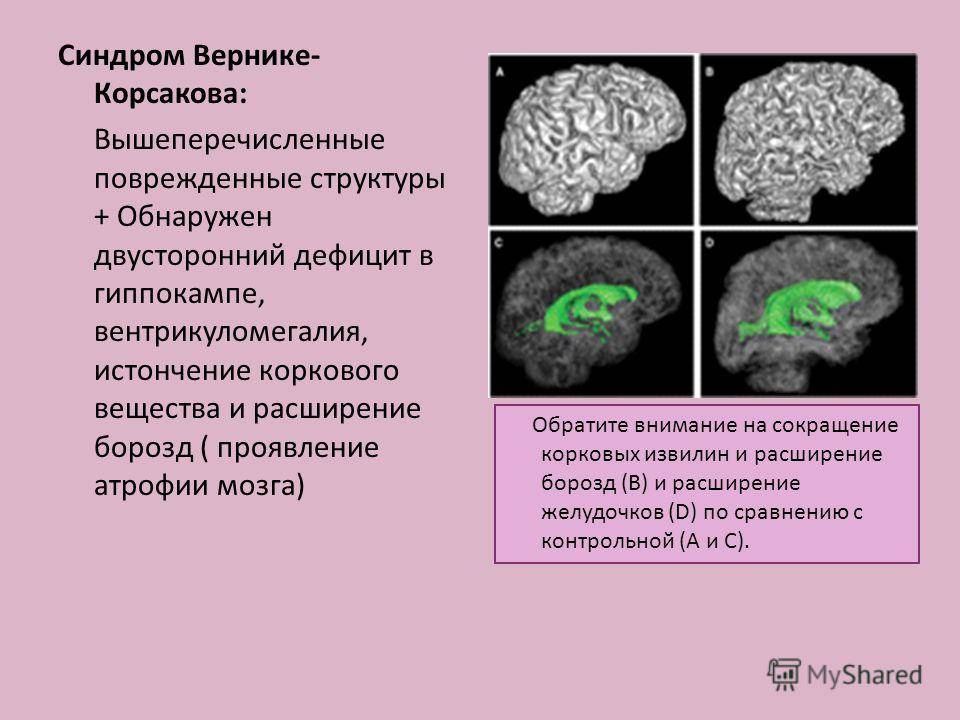 Алкогольная энцефалопатия презентация