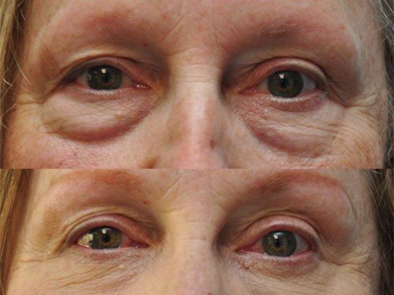Красные глаза после алкоголя