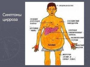 Звездочки при циррозе печени