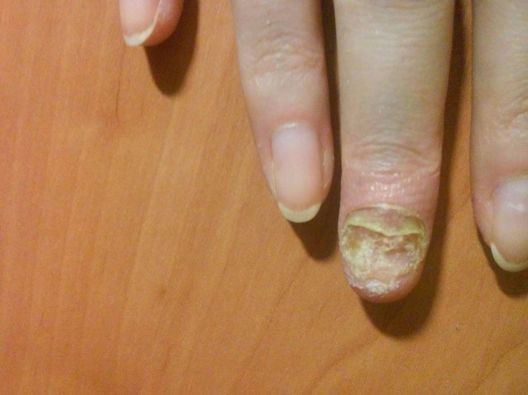 Желтые пальцы от сигарет: как убрать никотиновые пятна?