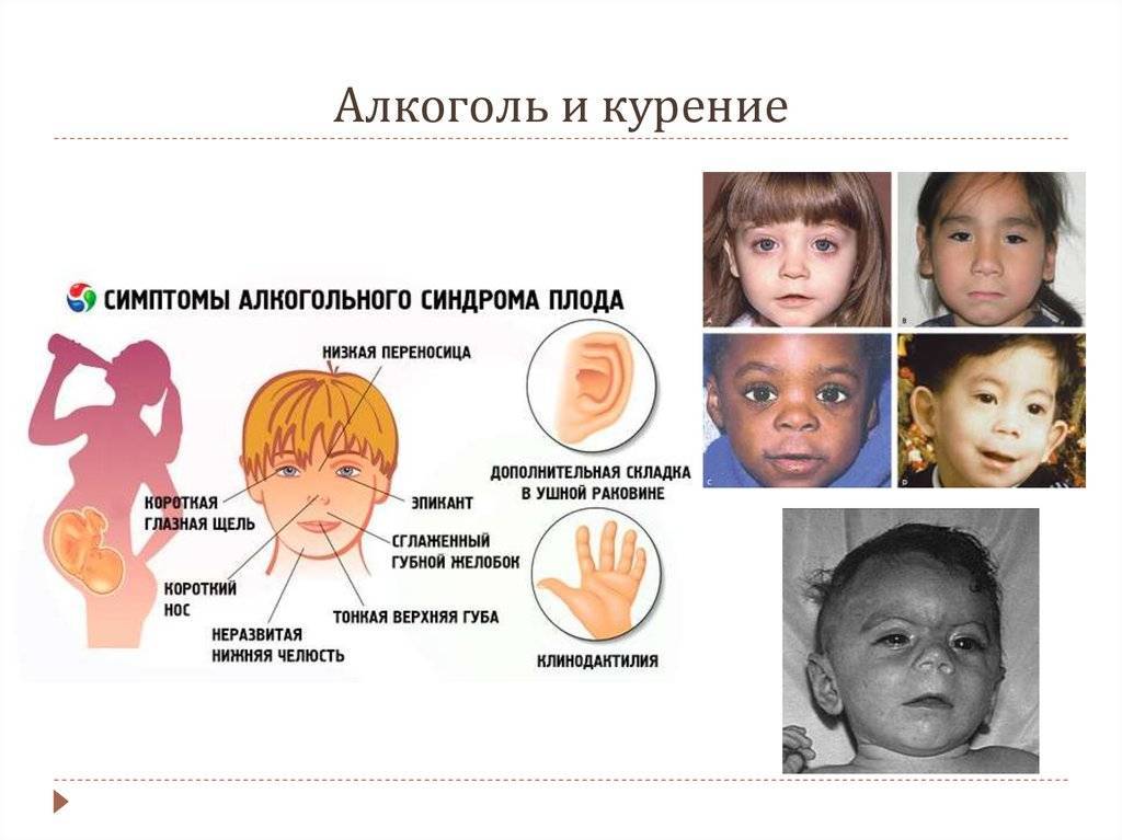 Взрослые дети алкоголиков. Фетальный алкогольный синдром плода. АСП алкогольный синдром плода. Алкогольный синдром плода (ФАС). Алкогольный синдром у детей.