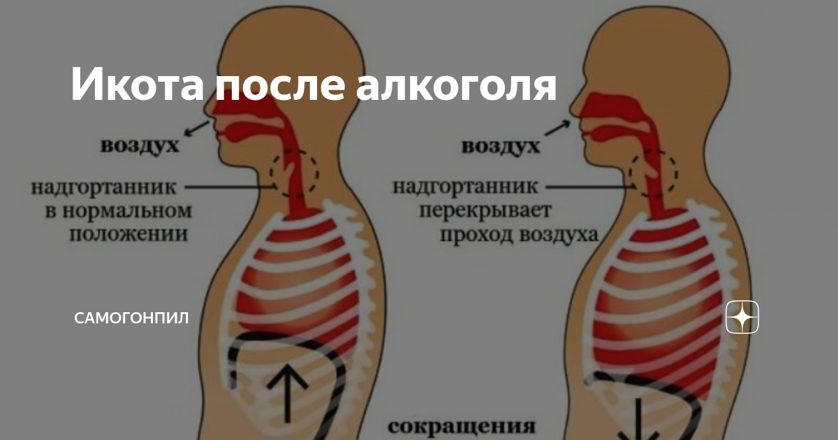 Как убрать икоту. Почему человек икает. Икота после алкоголя. Как перестать икать. Как избавиться от икоты.