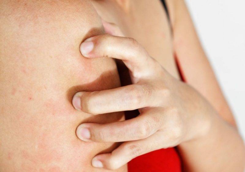 Как лечить кожный зуд при заболевании печени?? - твоя печенка