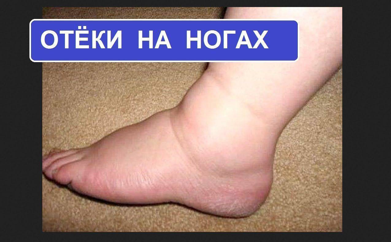 Как быстро снять отек ног в домашних условиях