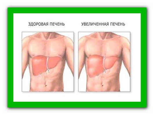 Увеличение признак. Увеличение размеров печени. Увеличение печени причины.