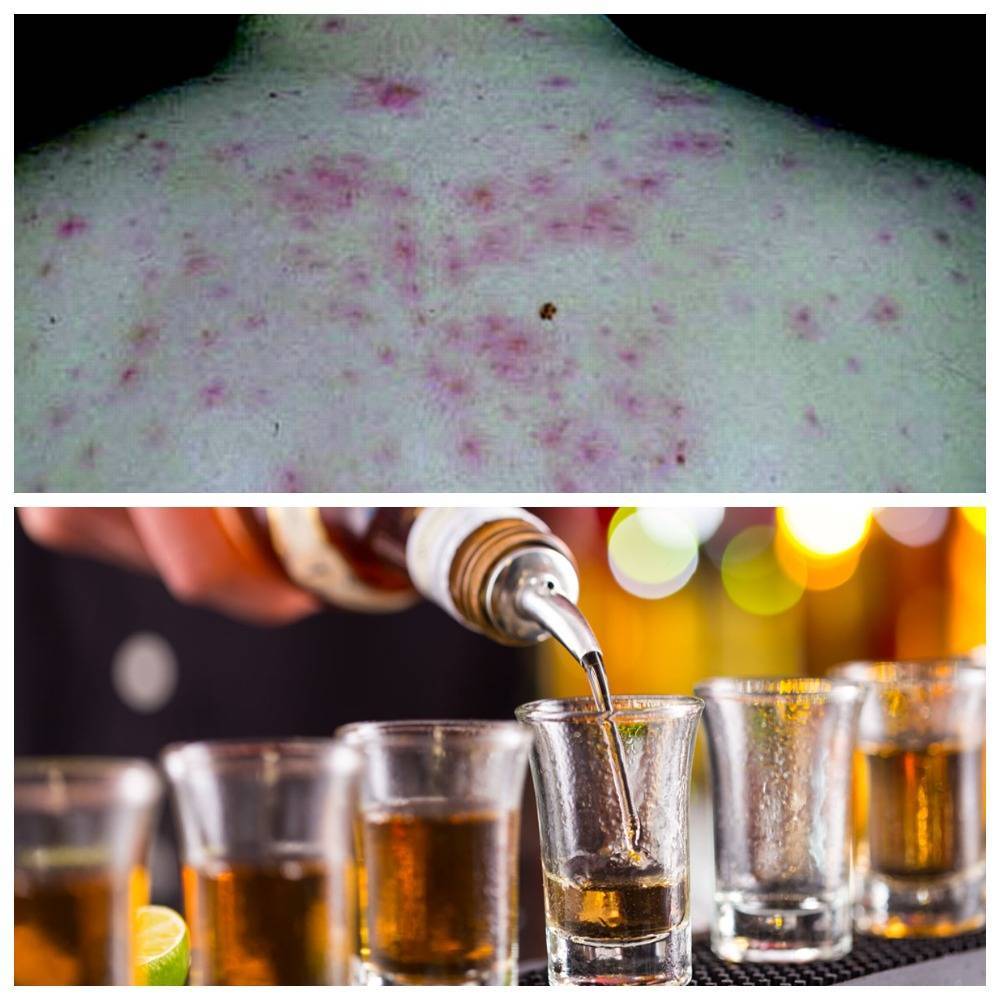 Аллергия на алкоголь – симптомы и как лечить