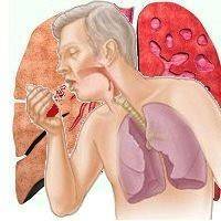 Как отличит кашель при туберкулезе и бронхите