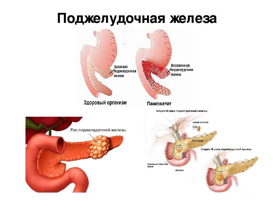 Поджелудочная железа алкоголика фото