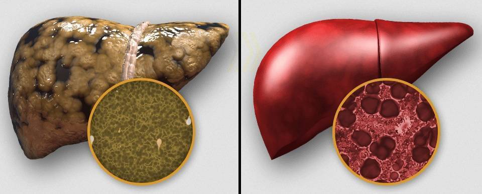 Алкоголь и печень картинки