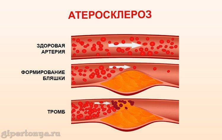 Как проверить сосуды на бляшки. Атеросклеротическая бляшка.