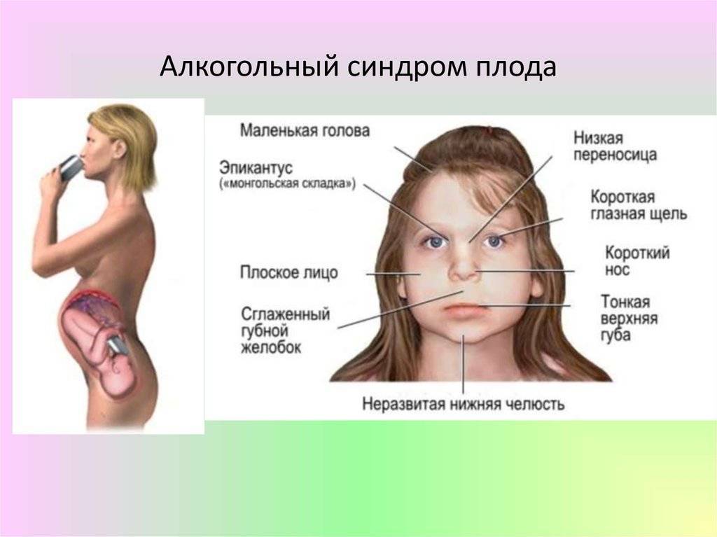 Алкогольный синдром картинки