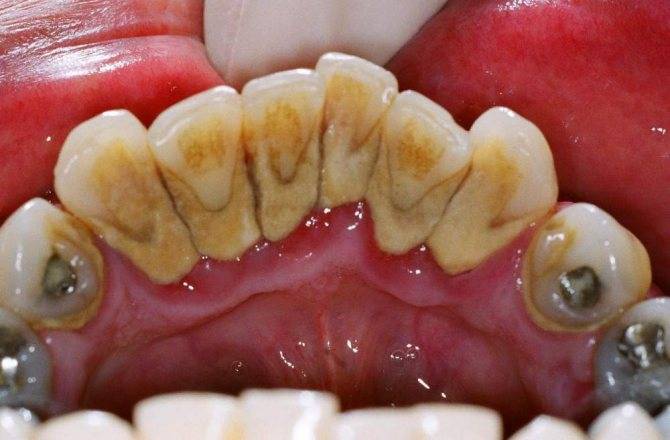 Чем опасен налет курильщика на зубах: действенные методы очистки от никотина и табачных смол