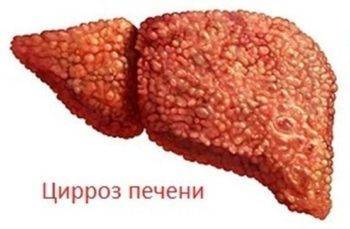 Инвалидность цирроз печени
