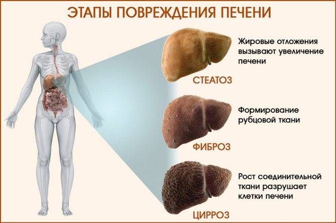 Декомпенсированный цирроз печени: симптомы, лечение, прогноз