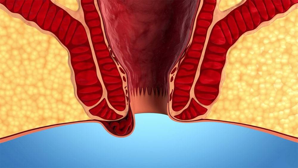 Кровь в заднем проходе у женщин причины. Внутренние геморройные узлы. Выпадение геморроидальных шишек.