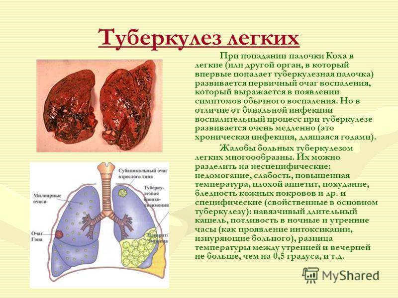 Кашель при туберкулезе легких: особенности, симптомы и лечение