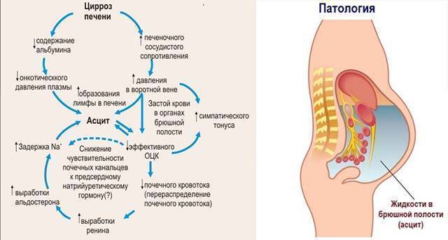Мочегонные при отеках брюшной полости