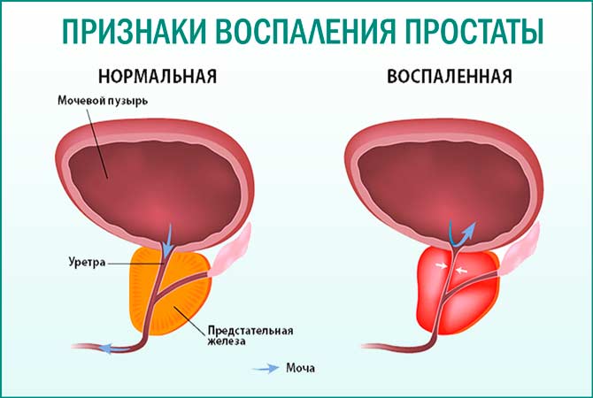 Воспаление простаты. Воспаление предстательной железы. Воспалительная болезнь предстательной железы. Простата у мужчин. Симптомы воспаленной простаты.