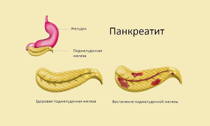 Поджелудочная железа воспаление. Загиб поджелудочной железы симптомы. Острый и хронический панкреатит. Заболевания поджелудочной железы у детей.