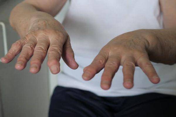 Тремор рук — причины, лечение народными средствами, препараты