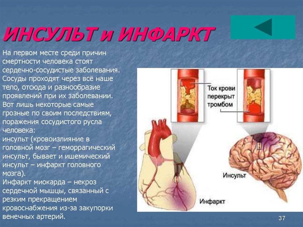 Ишемическая болезнь мозгов. Инсульт и инфаркт. Инфаркт миокарда и инсульт отличия. Что такое инсульт и что такое инфаркт миокарда. Инфаркт и инсульт разница.