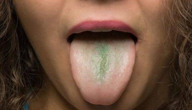 Сухость во рту: причины и лечение ксеростомии – таблетикс