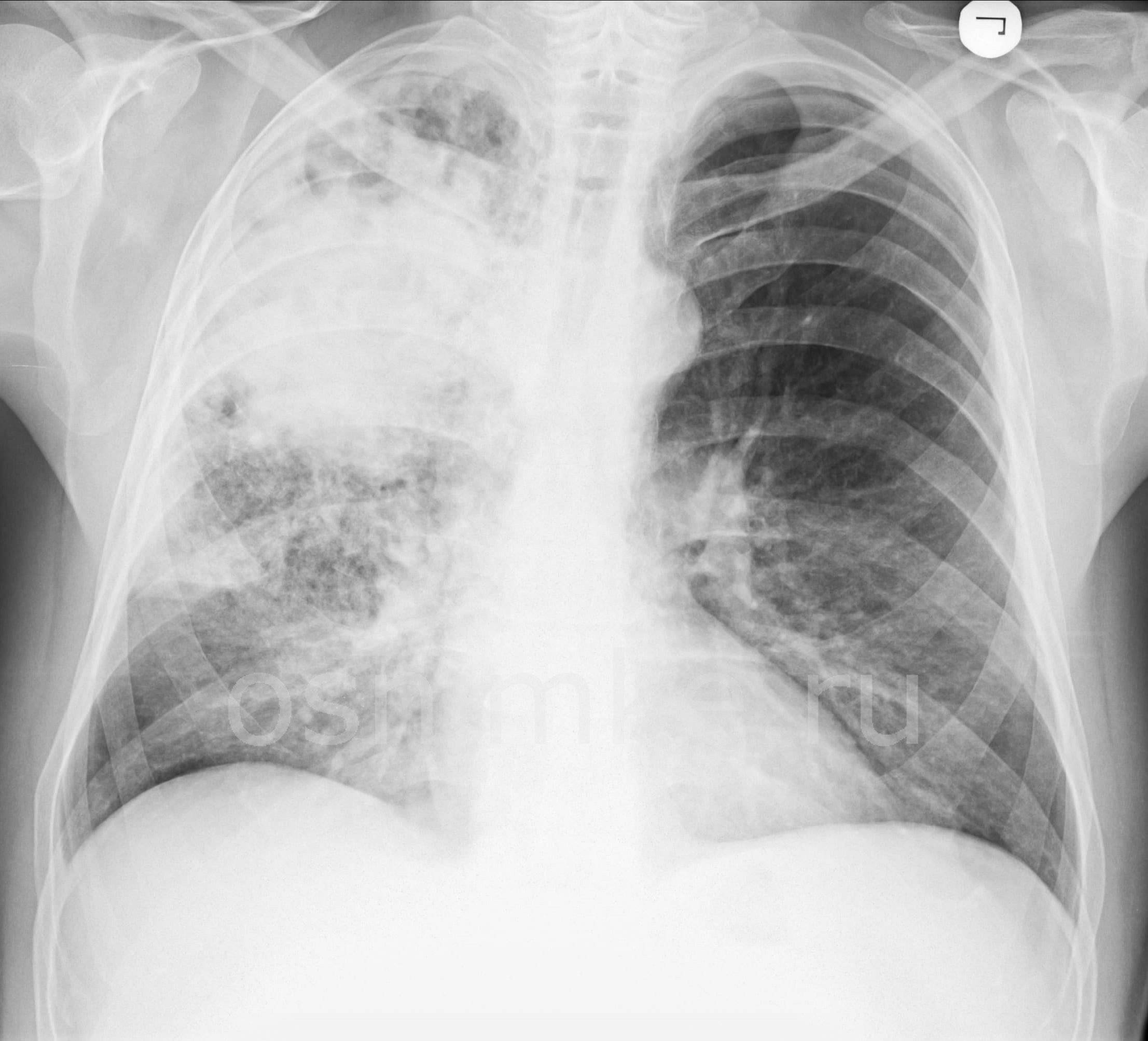 Здоровые лёгкие на рентгене | wine & water