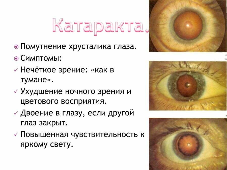 Причины заболевания катаракты