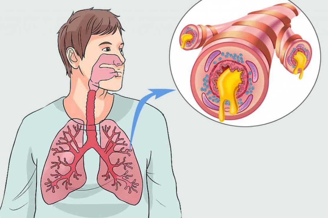 Бронхит у человека. Гнойно обструктивный бронхит. Острый и хронический бронхит. Симптомы поражения бронхов.