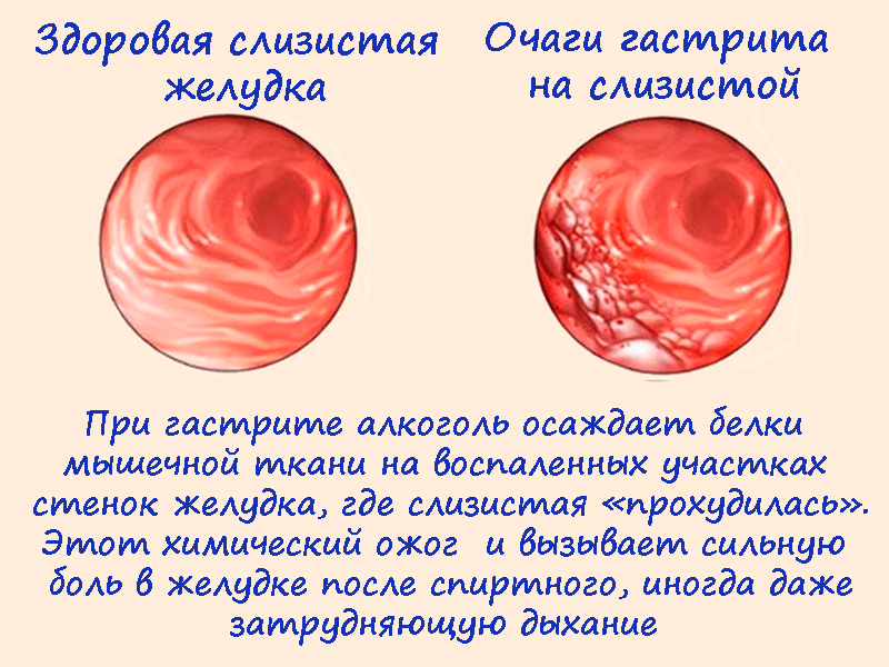 Почему на следующий день после. Болит желудок после алкоголя. Болит живот после алкоголя желудок. После спирта желудок болит. Почему после алкоголя болит желудок.