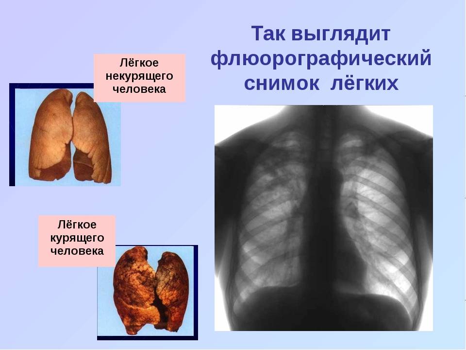 Показывает ли флюорография курение. Легкие здорового человека и курильщика на рентгене. Лёгкие курильщика на флюорографии и Здоровые легкие. Легкие курильщика и Здоровые на флюорографии. Легкие пассивного курильщика рентген.