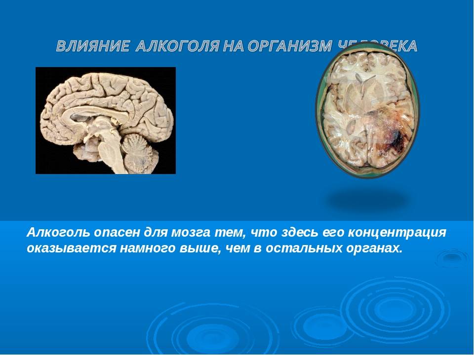 Мозг алкоголика и здорового человека картинки