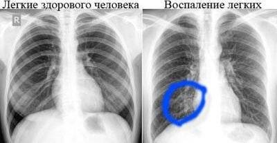 Как Выглядит Рентген Здоровых Легких Фото