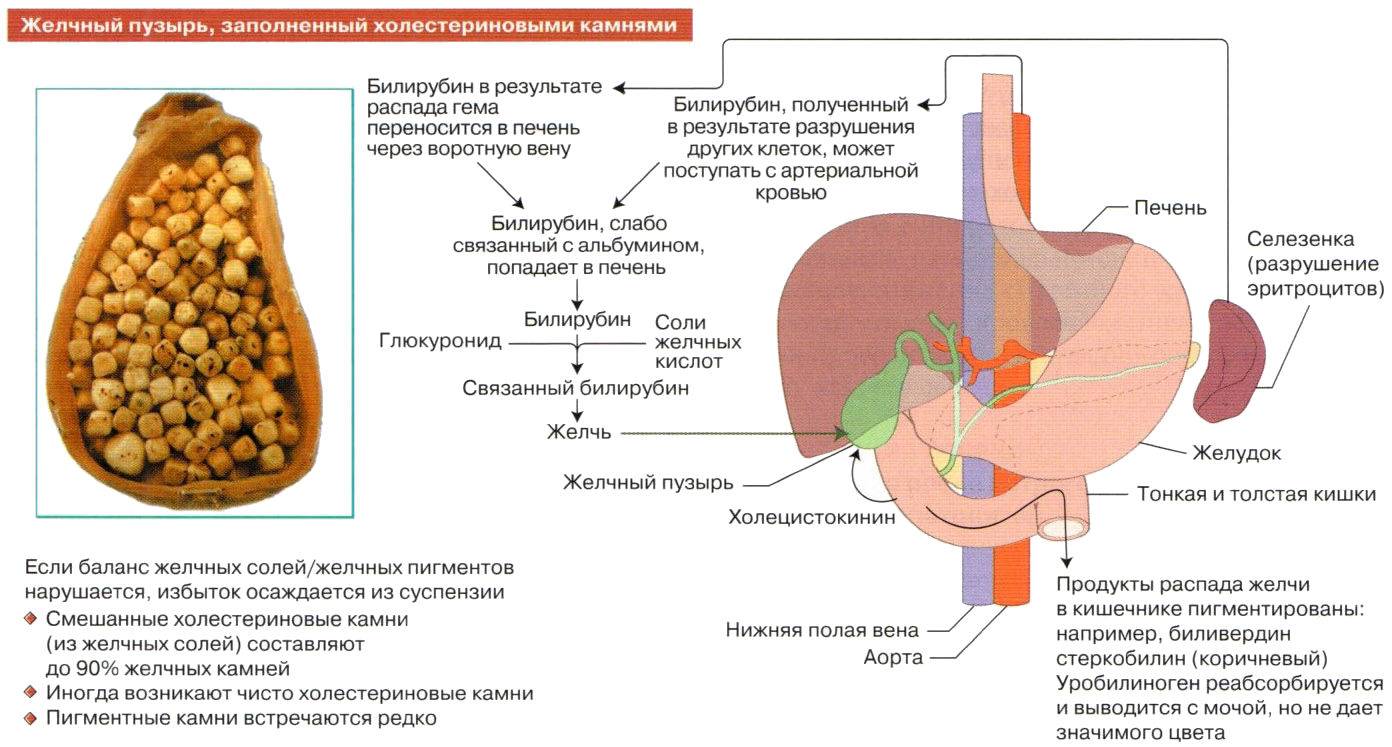 Можно ли при удаленном желчном пузыре. Образование камней в желчном пузыре. Удаляются ли камни желчного пузыря. Диета при камнях в желчном пузыре. Формирование желчного пузыря.