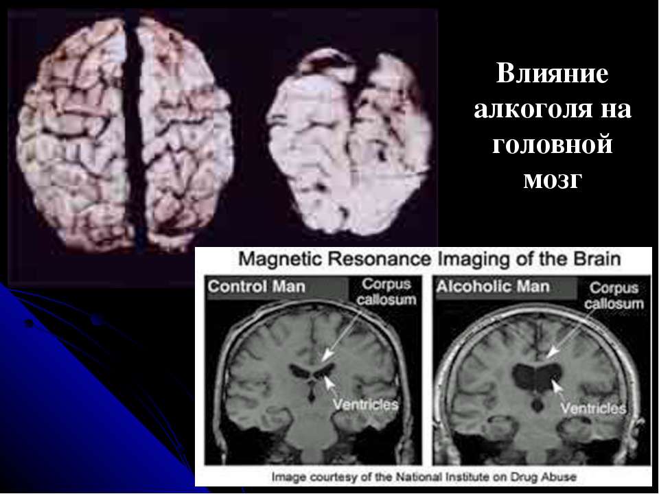 Мозг алкоголика и здорового человека картинки