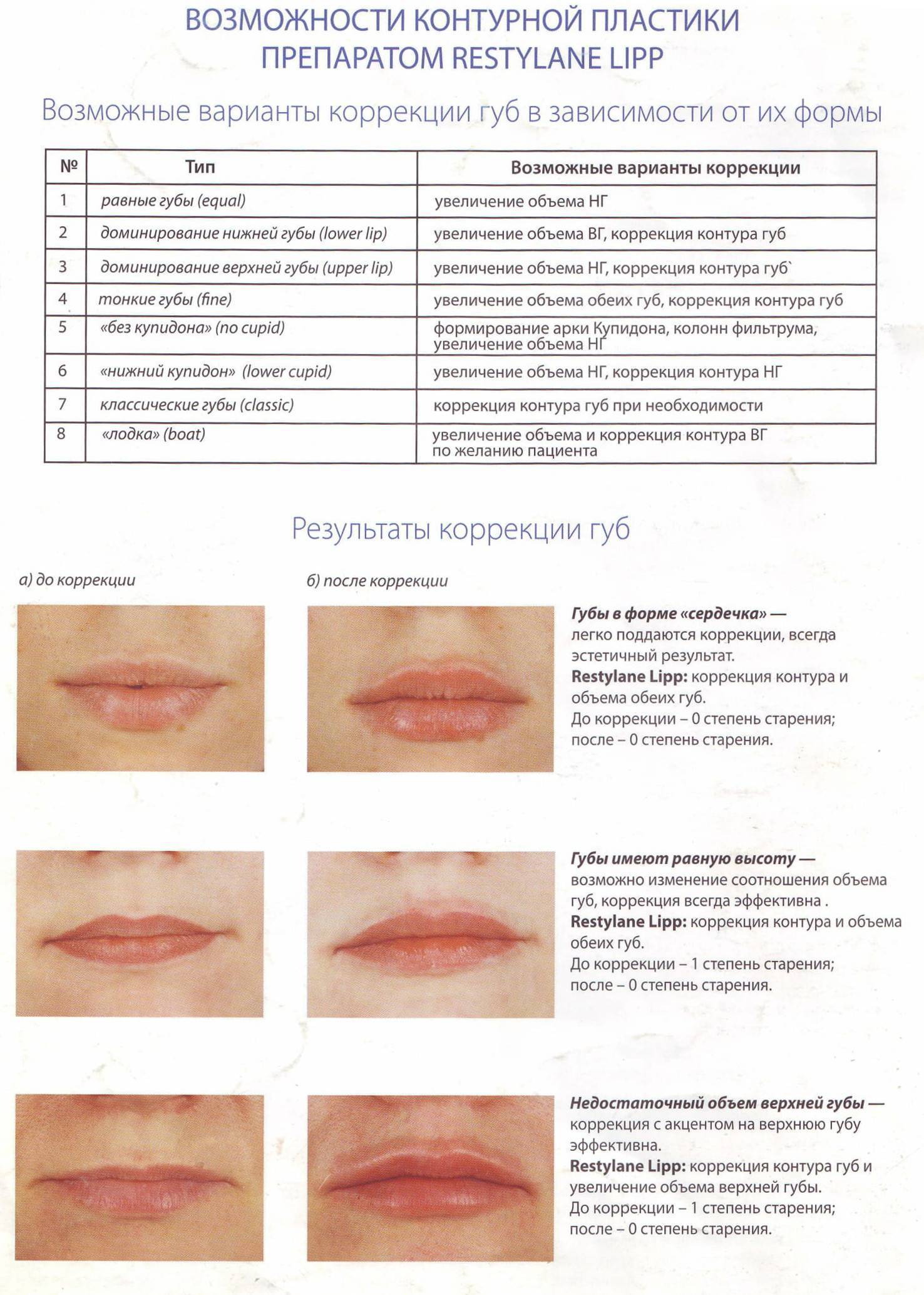 Как колоть губы гиалуроновой кислотой схема