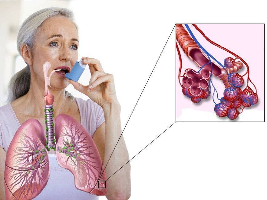 Можно ли пить алкоголь при астме: бронхиальной, атипической, комбинированной?