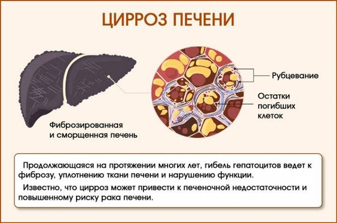Портальная гипертензия при циррозе печени