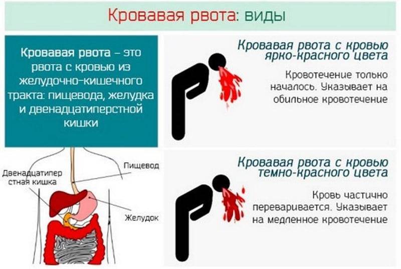 Периодически рвет. Отравление алкоголем симптомы.