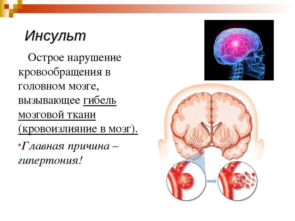 Инсульт дегеніміз не презентация