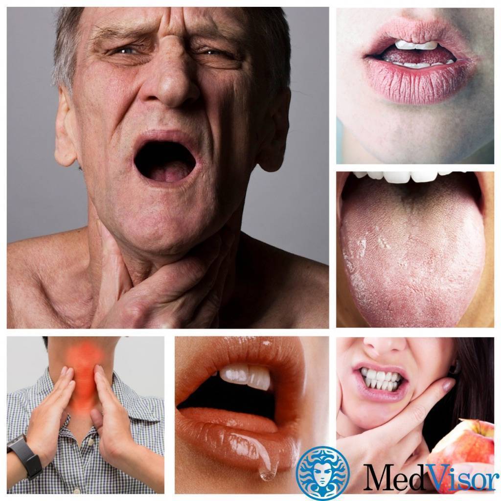 Сухость во рту: причины какой болезни ее вызывают и как от нее избавиться