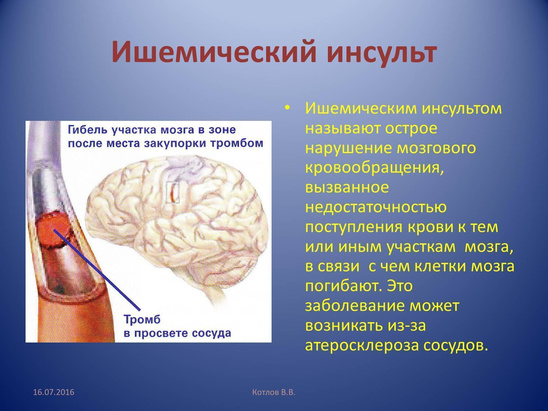 Алкоголь и инсульт: взаимосвязь, можно ли пить, вред или польза