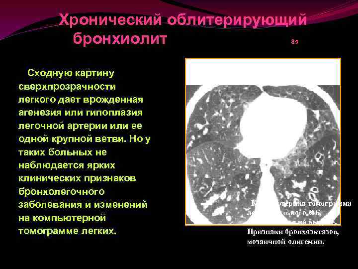 Бронхиолит это. Рестриктивный бронхиолит. Кт картина бронхиолита. Основные клинические проявления облитерирующего бронхиолита. Инфекционный бронхиолит кт.