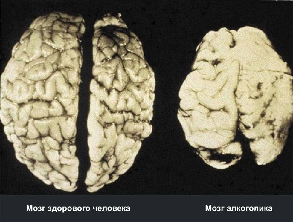 Можно ли употреблять алкоголь после инсульта