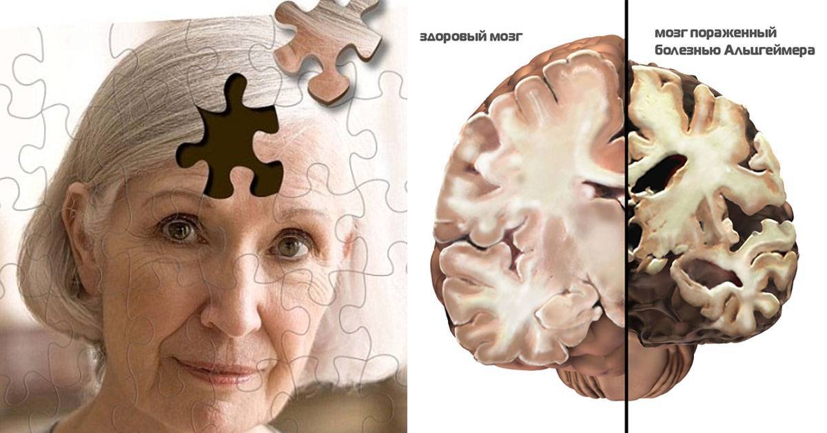 Сенильная дегенерация головного мозга как причина смерти: виды и стадии нарушения, старческий маразм, сколько живут на 3 степени, особенности ухода, профилактика