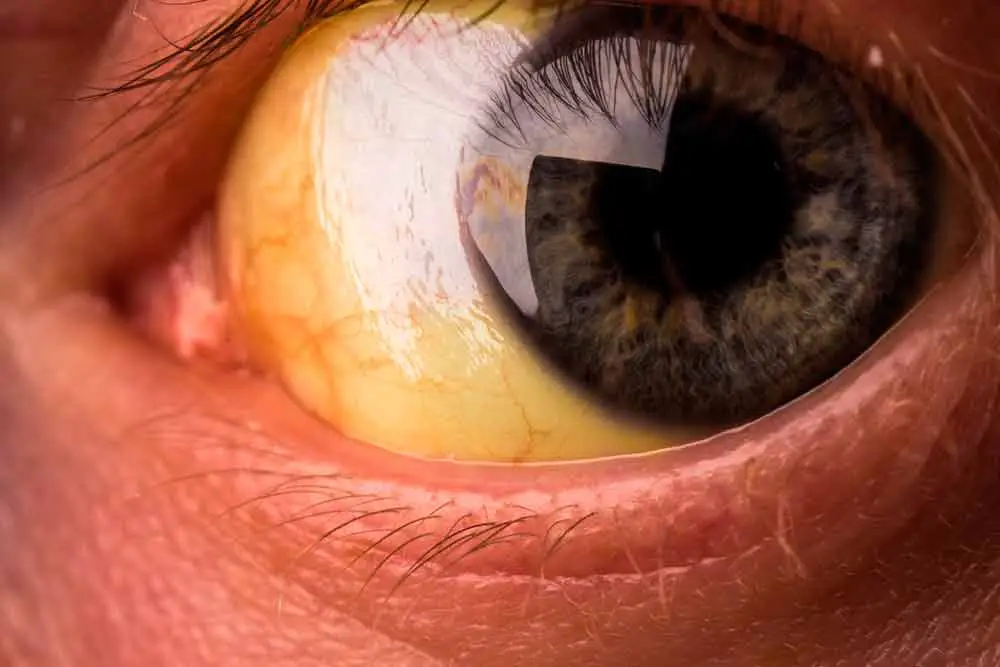 Желтые глаза: причины и лечение белков глаз, симптомы пожелтения склер у человека